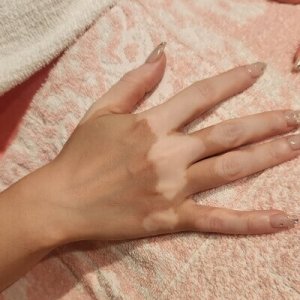 こんなに凄い「白斑」は初めて！