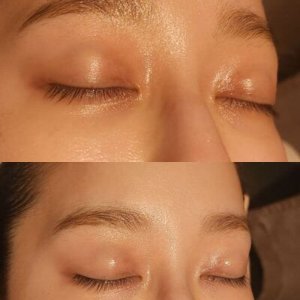 新技術⁉・・・瞼の黒ずみが白肌に！