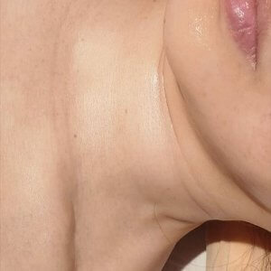 プラセンタは、手術の傷痕にも効果的！？