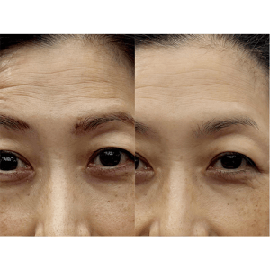 額のシワが1回で薄くなった！？