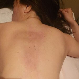 30年前のカッピングで、背中に大きな赤い痕！